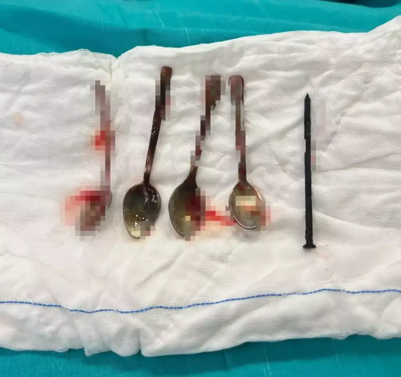 Kayseri'de 15 yaşındaki çocuğun midesinden 4 kaşık ve bir çivi çıktı