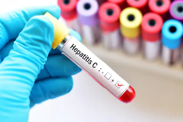Hepatit C nedir? Hepatit C tedavisi nasıl olur?