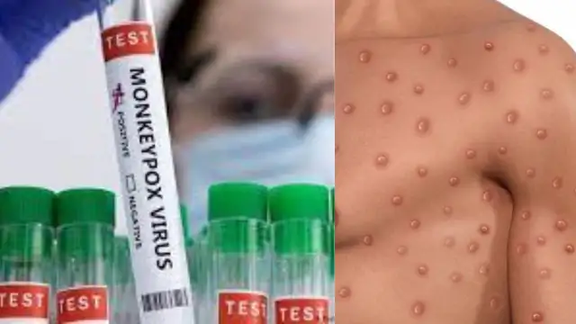 Maymun çiçeği virüsünün en çok görüldüğü 4 ülke: Aşılama başladı!