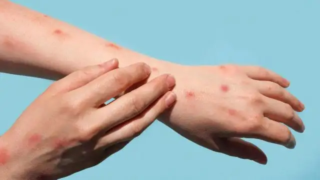 Kongo Demokratik Cumhuriyeti'nde M çiçeği vakalarının çoğu çocuk