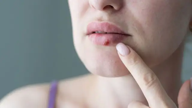 Umut veren araştırma: Modifiye edilmiş herpes virüsü, kanser hücrelerini yendi