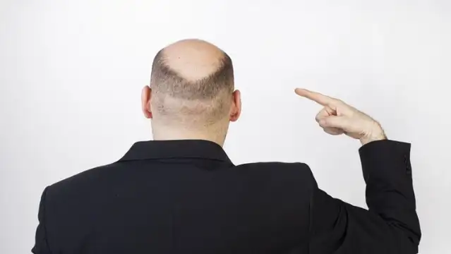 Kelliğin sırrı çözüldü… Tedavisi eski çağlara kadar uzanıyor
