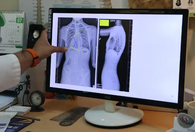 Çocuklarda ergenlik öncesi skolyoz kontrolü tedavi şansını artırıyor