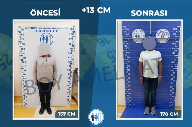 Boy Uzatma Ameliyatı: Süreç ve Dikkat Edilmesi Gerekenler