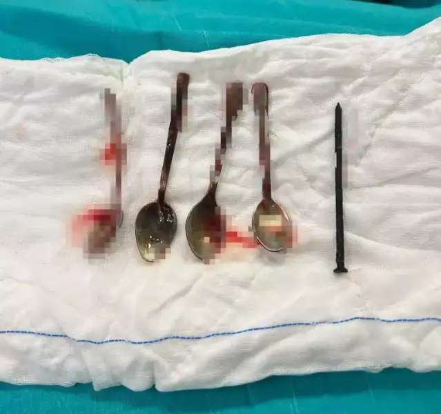 Kayseri'de 15 yaşındaki çocuğun midesinden 4 kaşık ve bir çivi çıktı