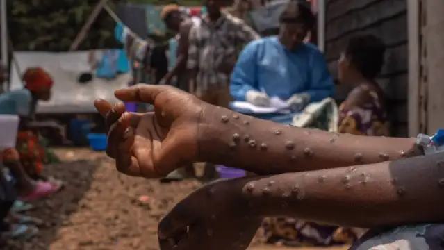 CDC: Maymun çiçeği salgını Afrika'da kontrolden çıktı