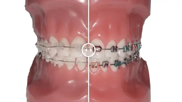 Estetik Gülüşler İçin Diş Teli Tedavisinde Yeni Nesil Yaklaşımlar